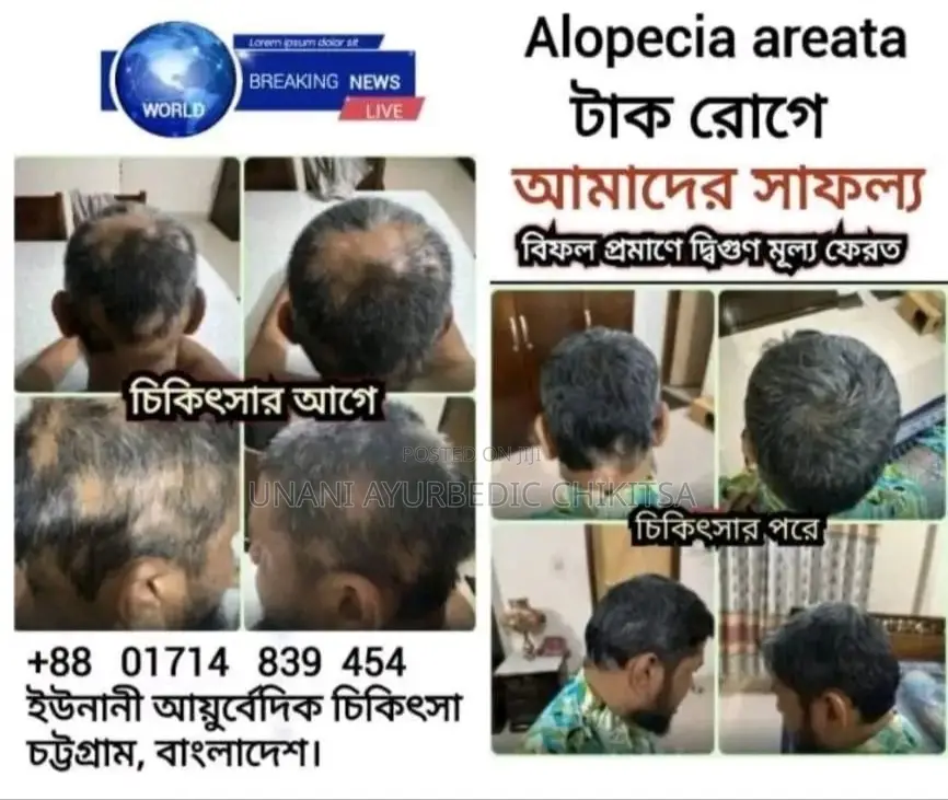 Alopecia টাক রোগে চুল গজাবে স্থায়ী ভাবে-ইউনানী আয়ুর্বেদিক