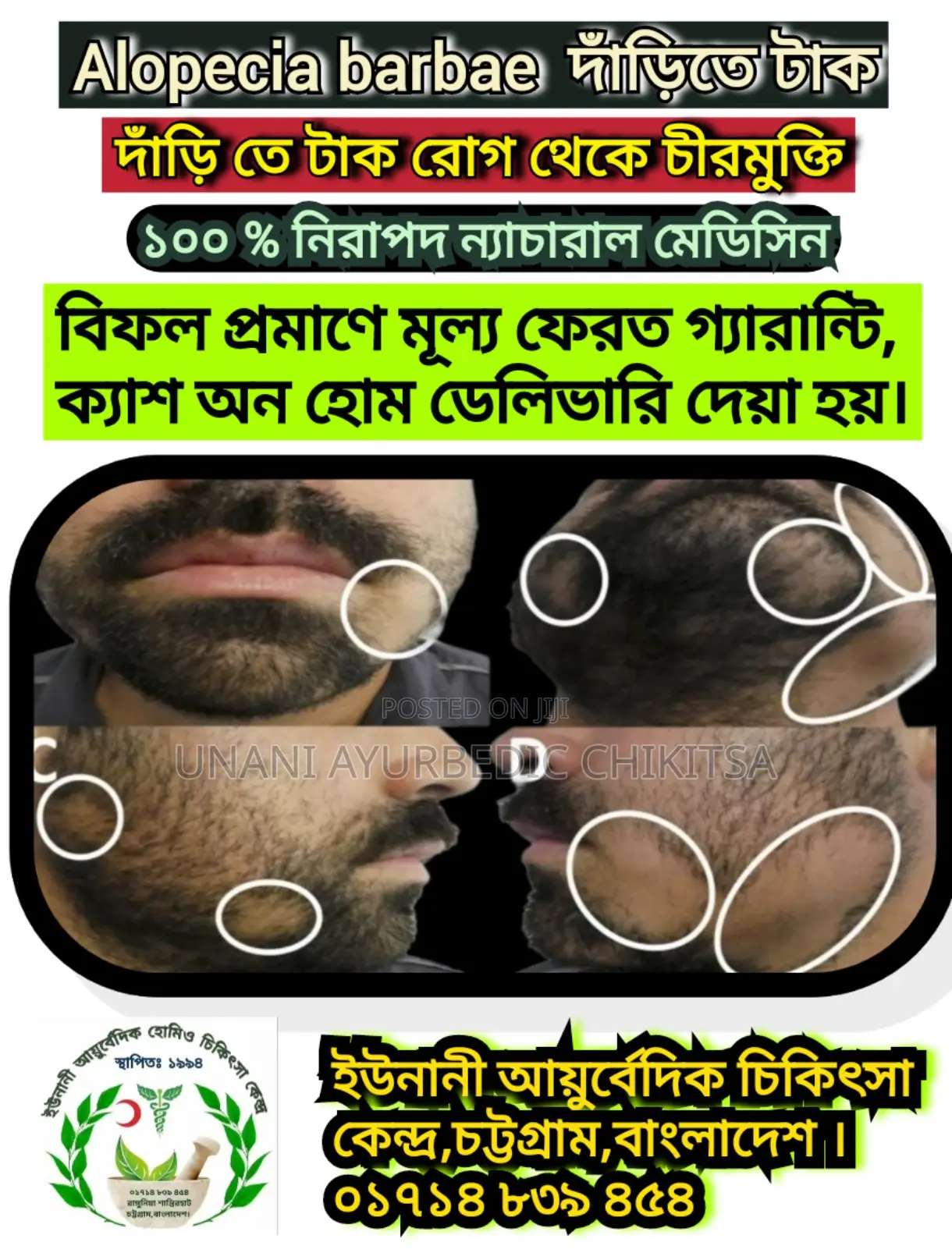 Alopecia টাক রোগে চুল গজাবে স্থায়ী ভাবে-ইউনানী আয়ুর্বেদিক