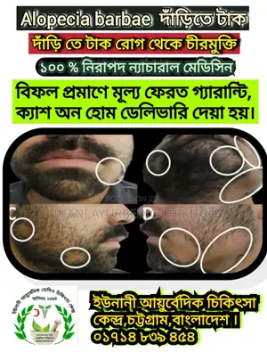 Alopecia টাক রোগে চুল গজাবে স্থায়ী ভাবে-ইউনানী আয়ুর্বেদিক