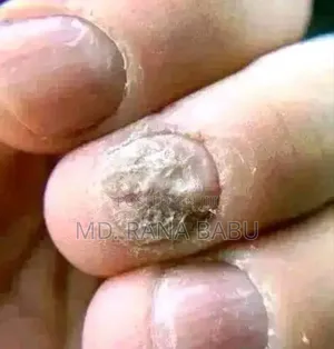 Efro Nail Repair Essence Gel Fungal Nail