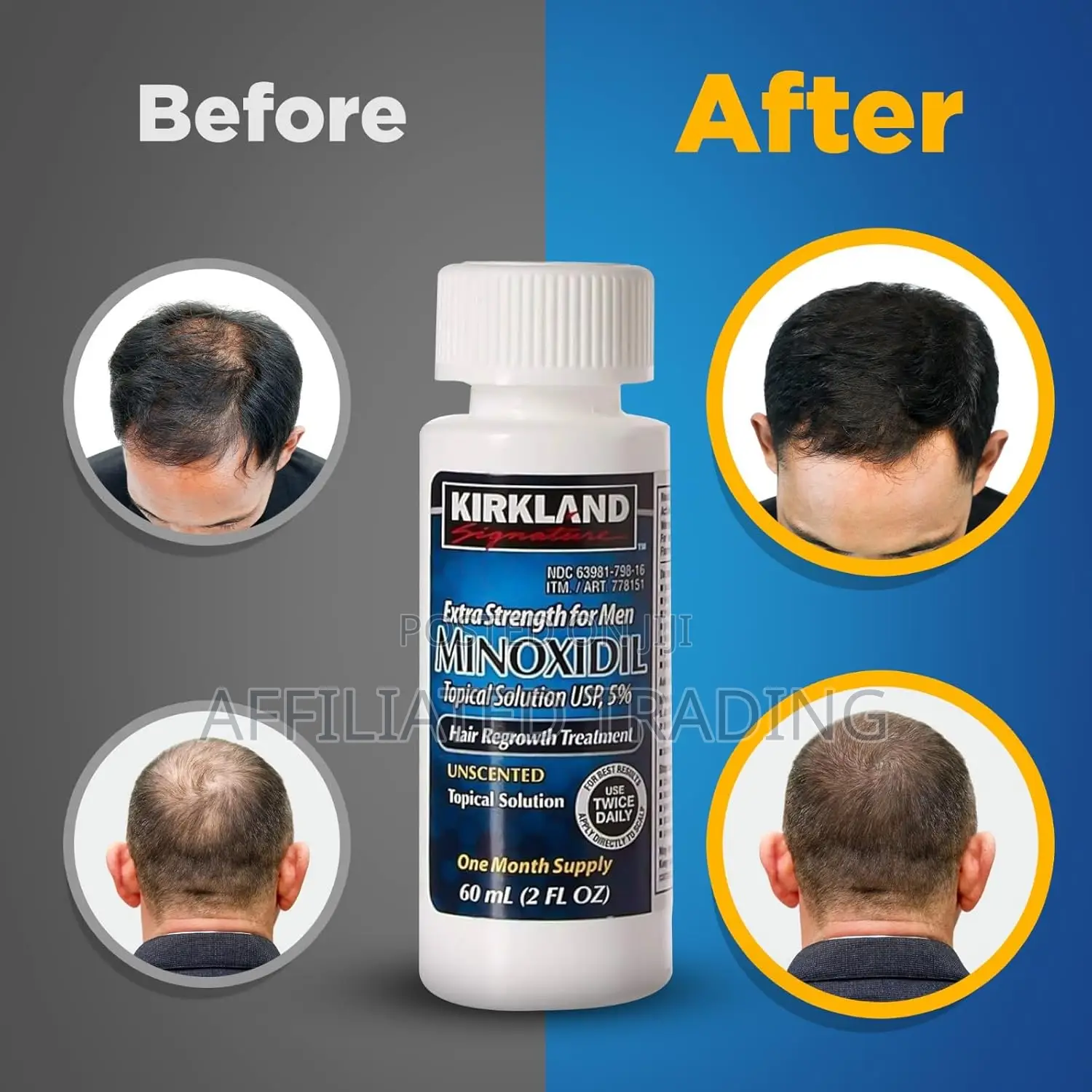 Kirkland Minoxidil 5% for Beard Hair Growth Made in Usa