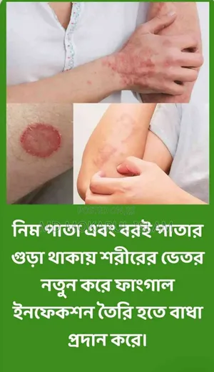Allergy Binash (Allergy Relief)