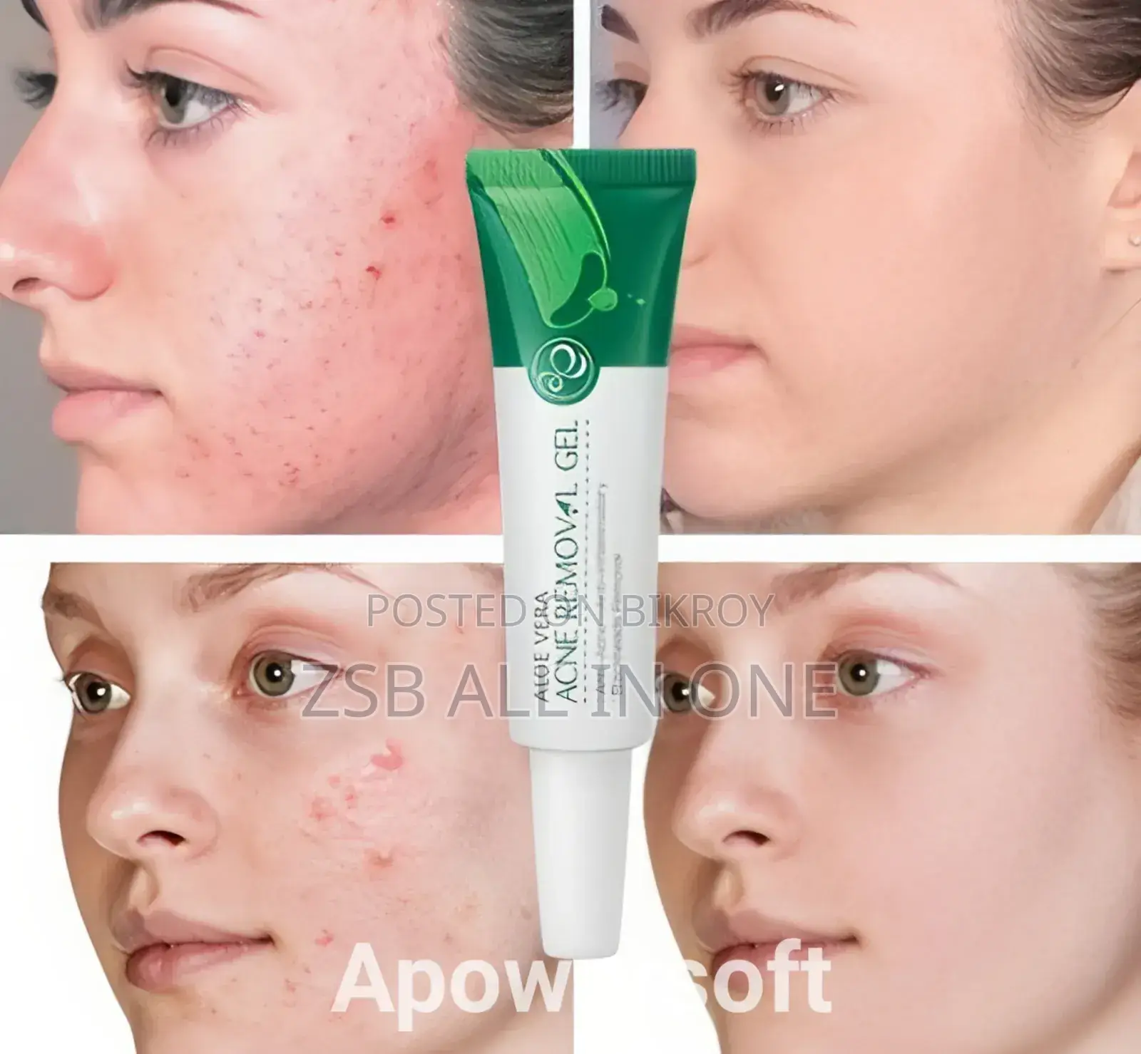 Aloe Vera Acne Removal Gel