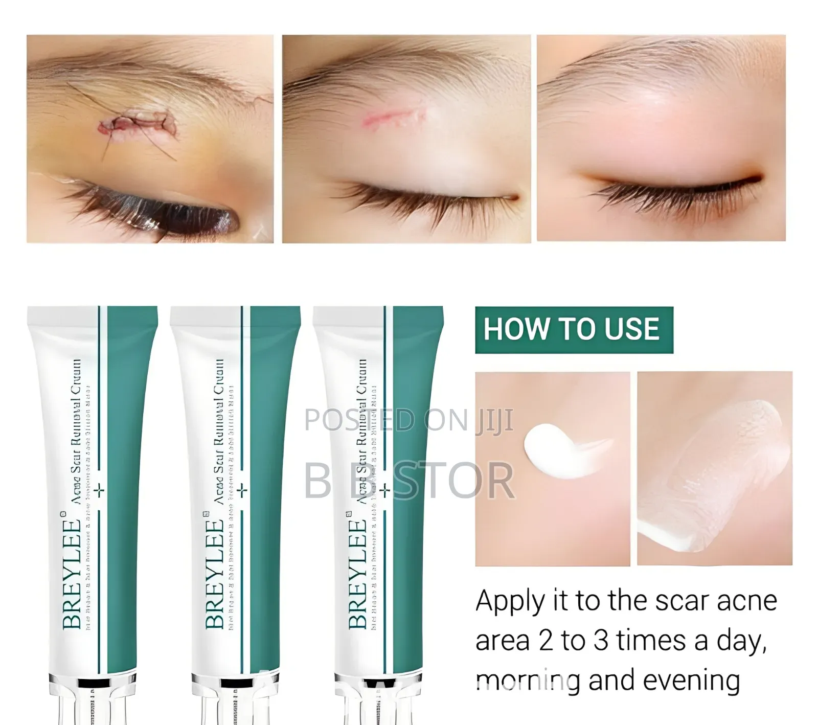 Breylee Acne Scar Removal Cream