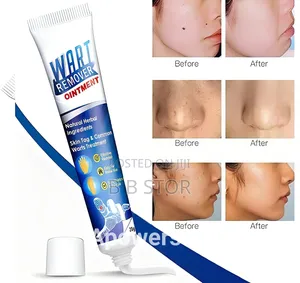 Wart Remover Ointment Best Product