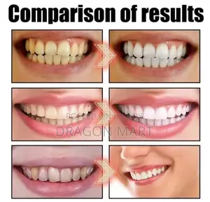 Hismile V34 Color Corrector for a Beautiful and Confident Smile