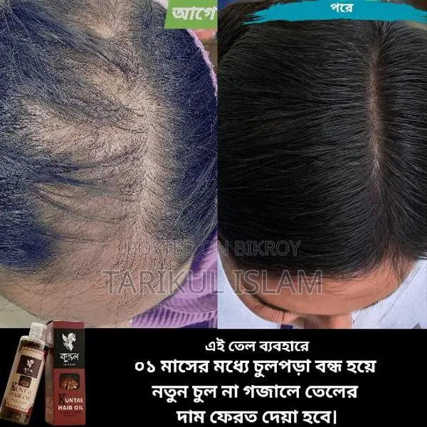 চুল পড়া নিয়ে চিন্তিত? সমাধান এখন আপনার হাতেই!