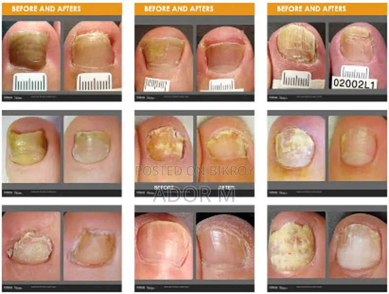 Nail Fungal Infection Treatment
