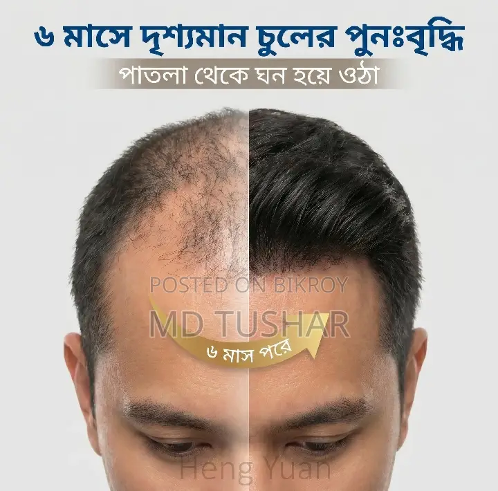 Minoxidil 5%