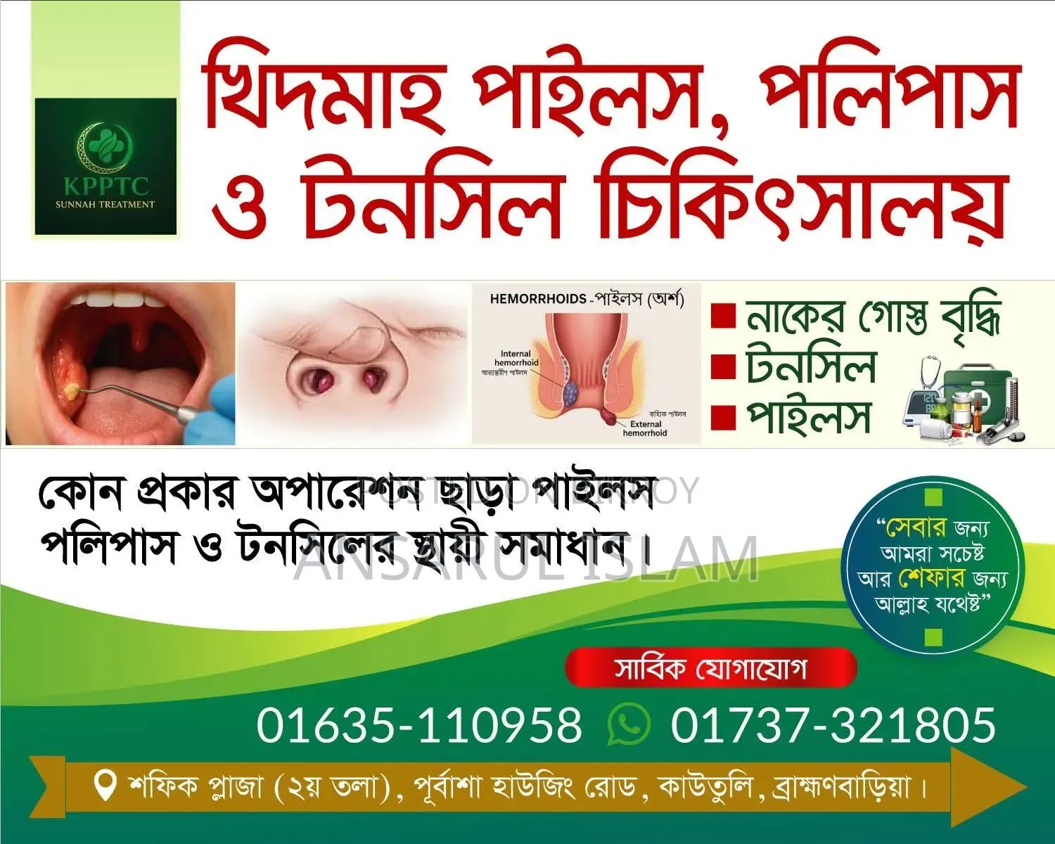 Treatment for Polyps, Piles, and Tonsils