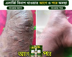 এলার্জি বিনাশ