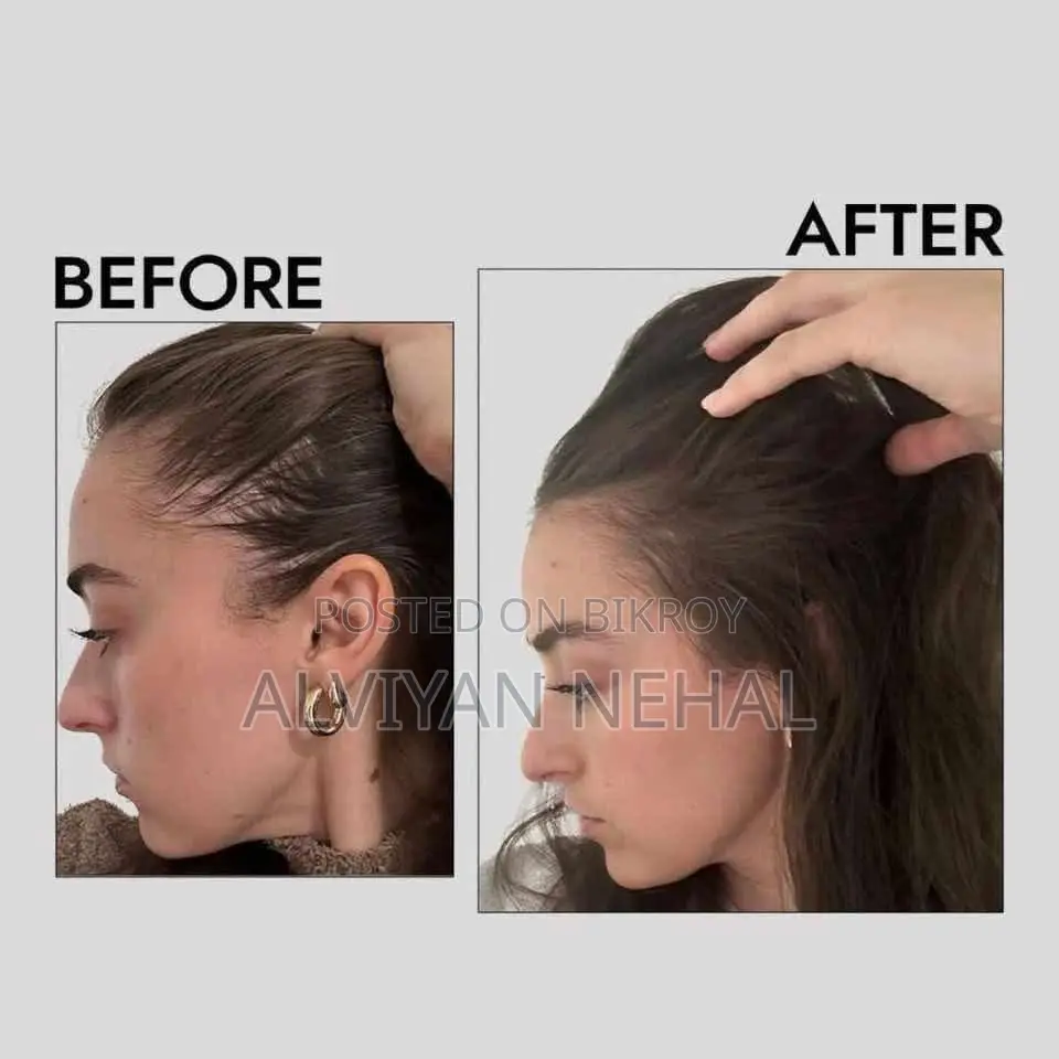 Anti Hair Loss Scalp Tonic. চুল পড়া বন্ধ করার সিরাম